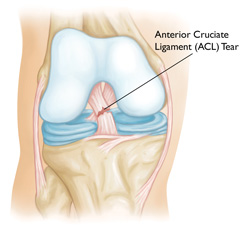 Anterior Cruciate Ligament Tears pic